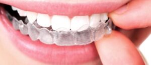 how-long-does-it-take-to-get-used-to-invisalign_1753703246