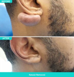 how-much-is-keloid-removal_1753700599